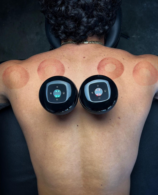 BENEFITS OF CUPPING THERAPY AT HOME